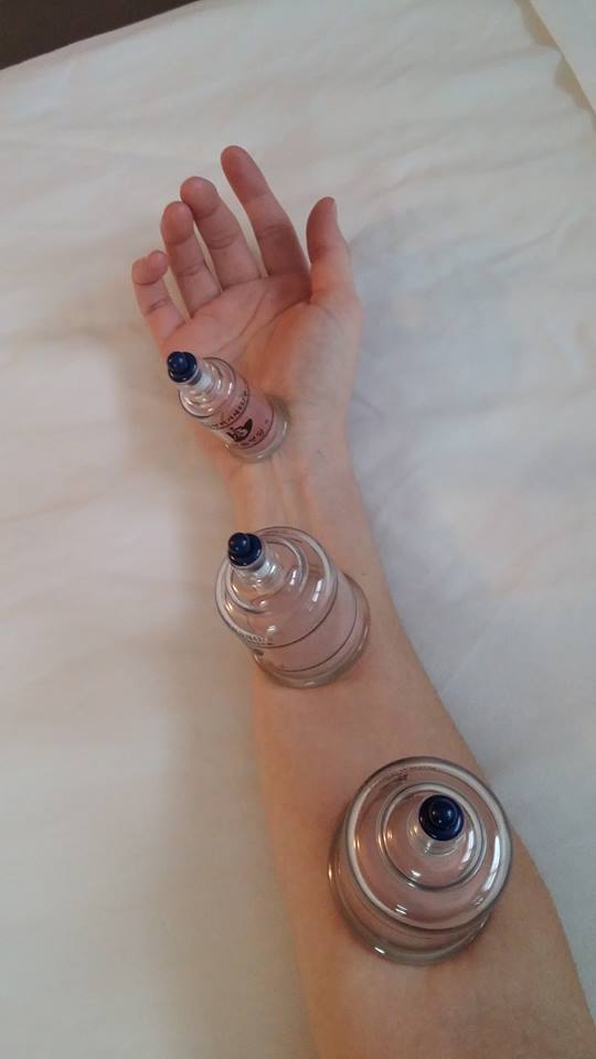 Cupping Arm